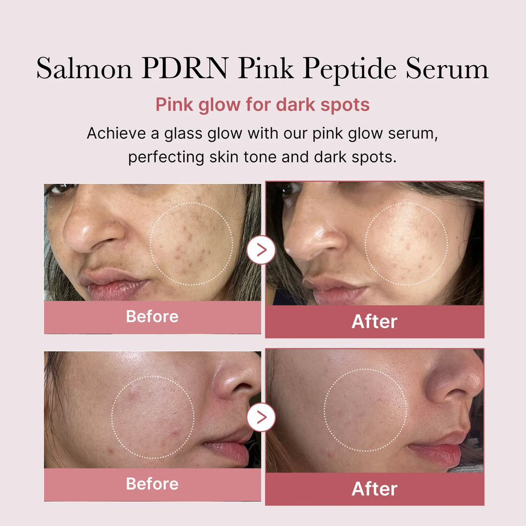 Before and after effects of Salmon PDRN Pink Peptide Serum on skin with dark spots.